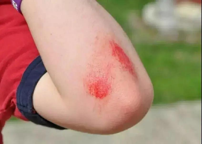 被马蜂叮咬后怎样处理,小磕小碰刮擦自己处理