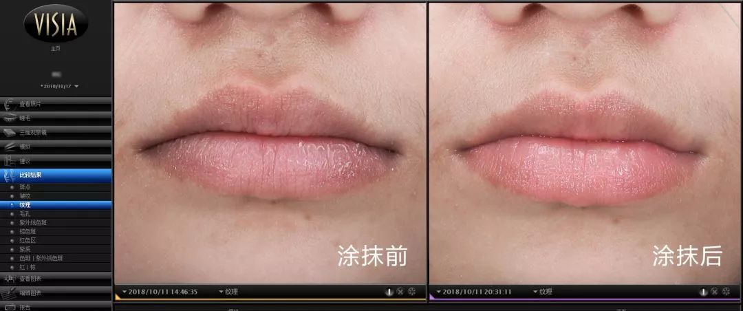 在线等，接吻时咬下女友的死皮，怎么办？