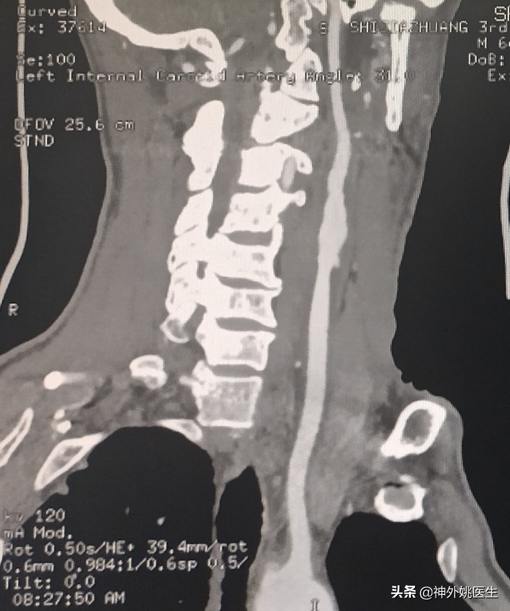 颈动脉狭窄的外科治疗