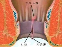 肛肠痔瘘的症状有哪些,痔疮肛裂肛窦炎怎么治