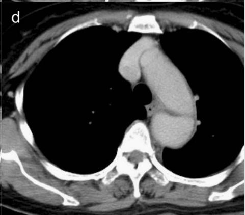 如何监测动脉夹层早期,动脉增强ct能查出主动脉夹层么