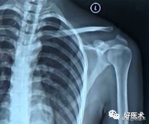 肩锁关节脱位手术后多久可以喝酒,肩锁关节脱位钢板内固定步骤记录