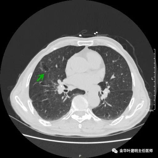 多发原发肺癌能根治吗,肺部原发性恶性肿瘤好治