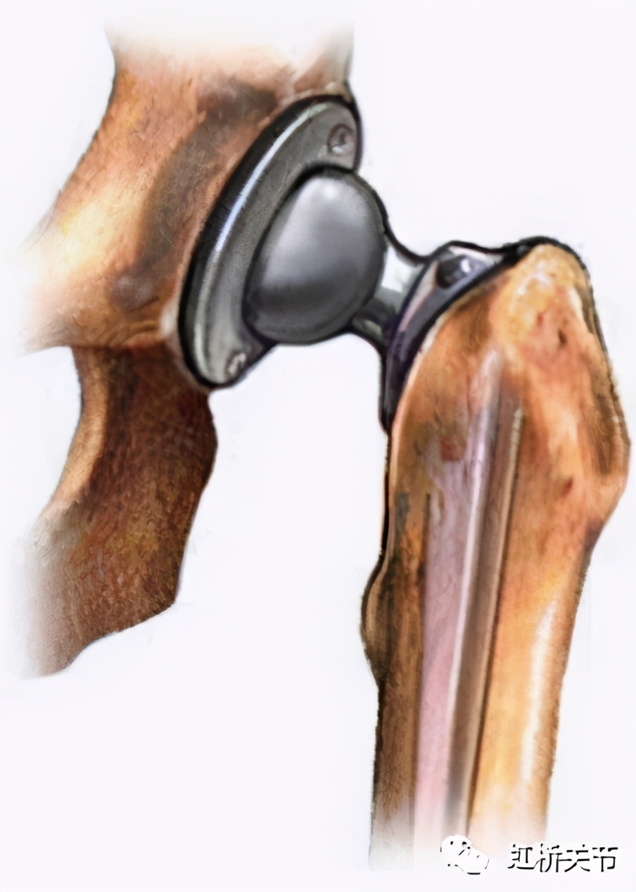 全髋关节置换多久不会感染,关节置换后怎么预防感染
