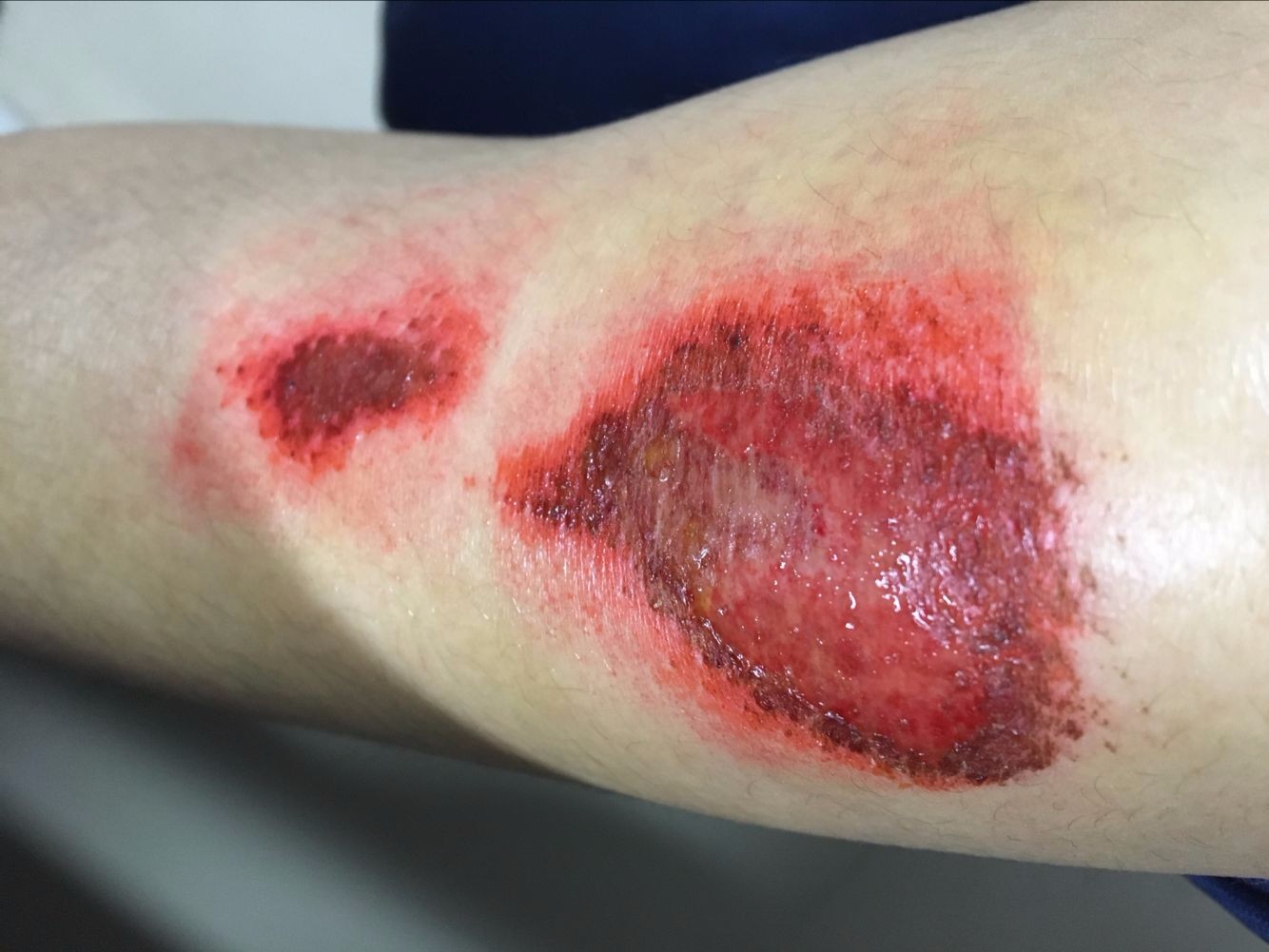 儿童手指夹伤怎么处理,三岁女童手指被压断后续