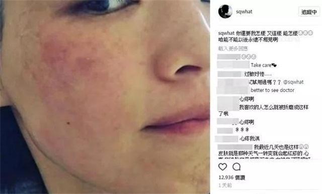 春季换季过敏怎么办,春季换季过敏