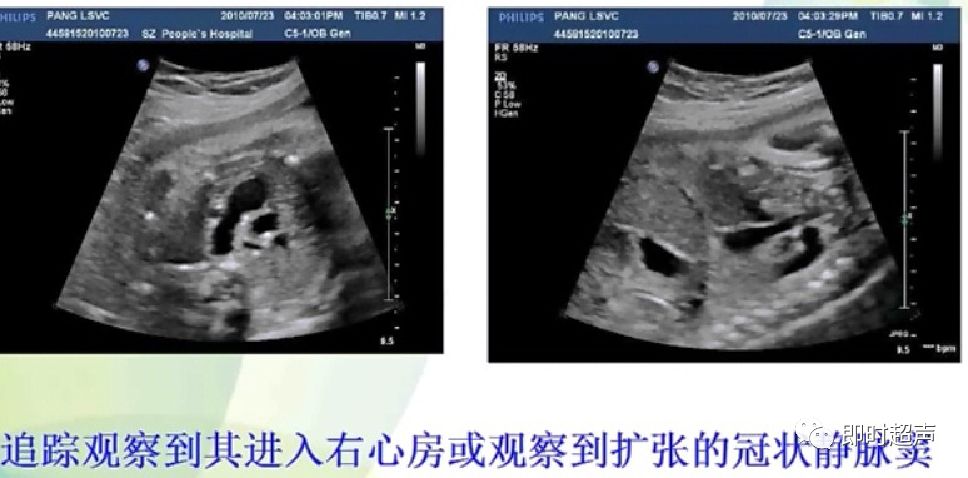 胎儿心脏三种血管关系模式图,25周的胎儿心脏弓切面多少正常