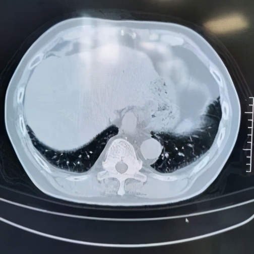 阵发性房颤和用药有关系吗,房颤药物控制好了还会复发吗