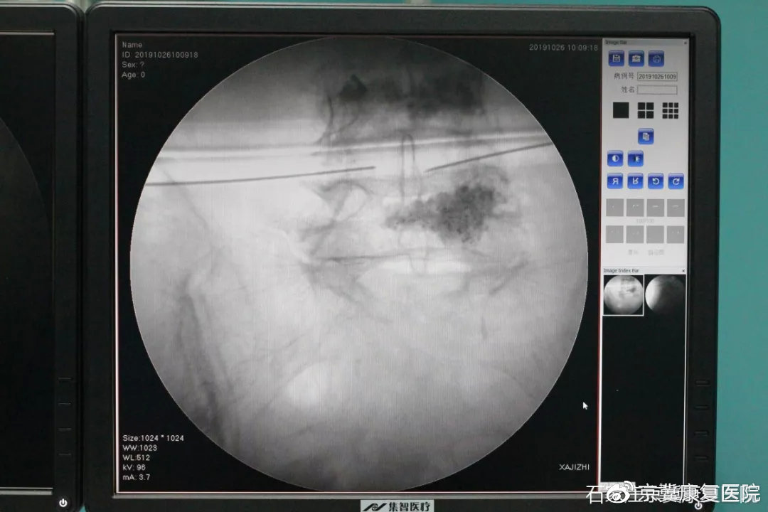 腰椎间盘突出不做手术最好的方法,腰椎间盘突出坚持不手术