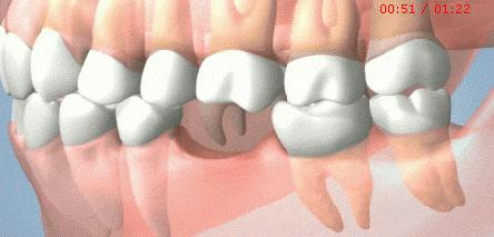 牙齿的普通治疗与根管治疗,根管治疗最严重的牙齿