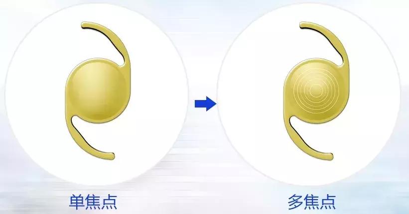 用激光治疗后发性白内障更模糊,患白内障造成看事物模糊