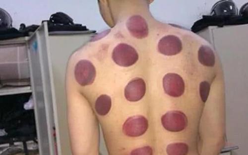 拔罐的黑印真的是体内毒素吗？拔罐师傅给出解释，看完长见识了！