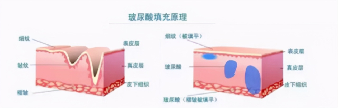 医美最应该做的项目有哪些,最常见的医美项目