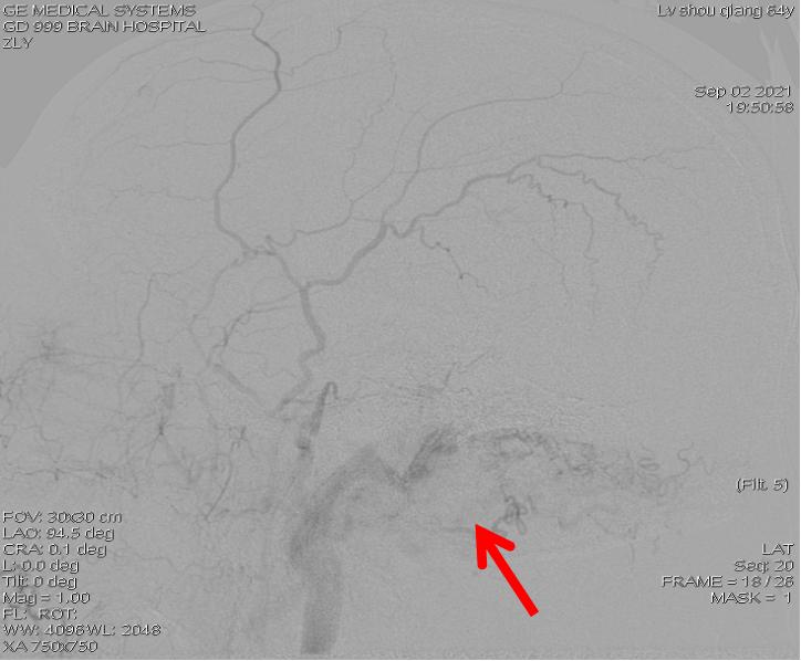 耳鸣4年，四处求医未果，这次治好了