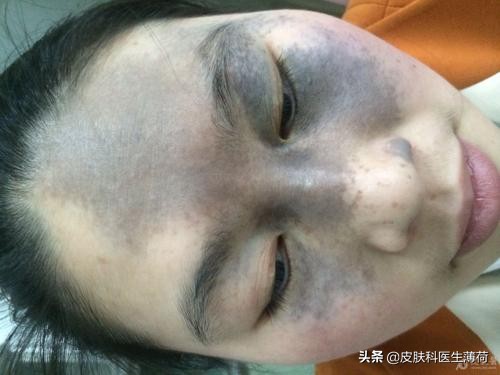 脸上激光了能喝中药吗,激光祛斑可以喝中药吗