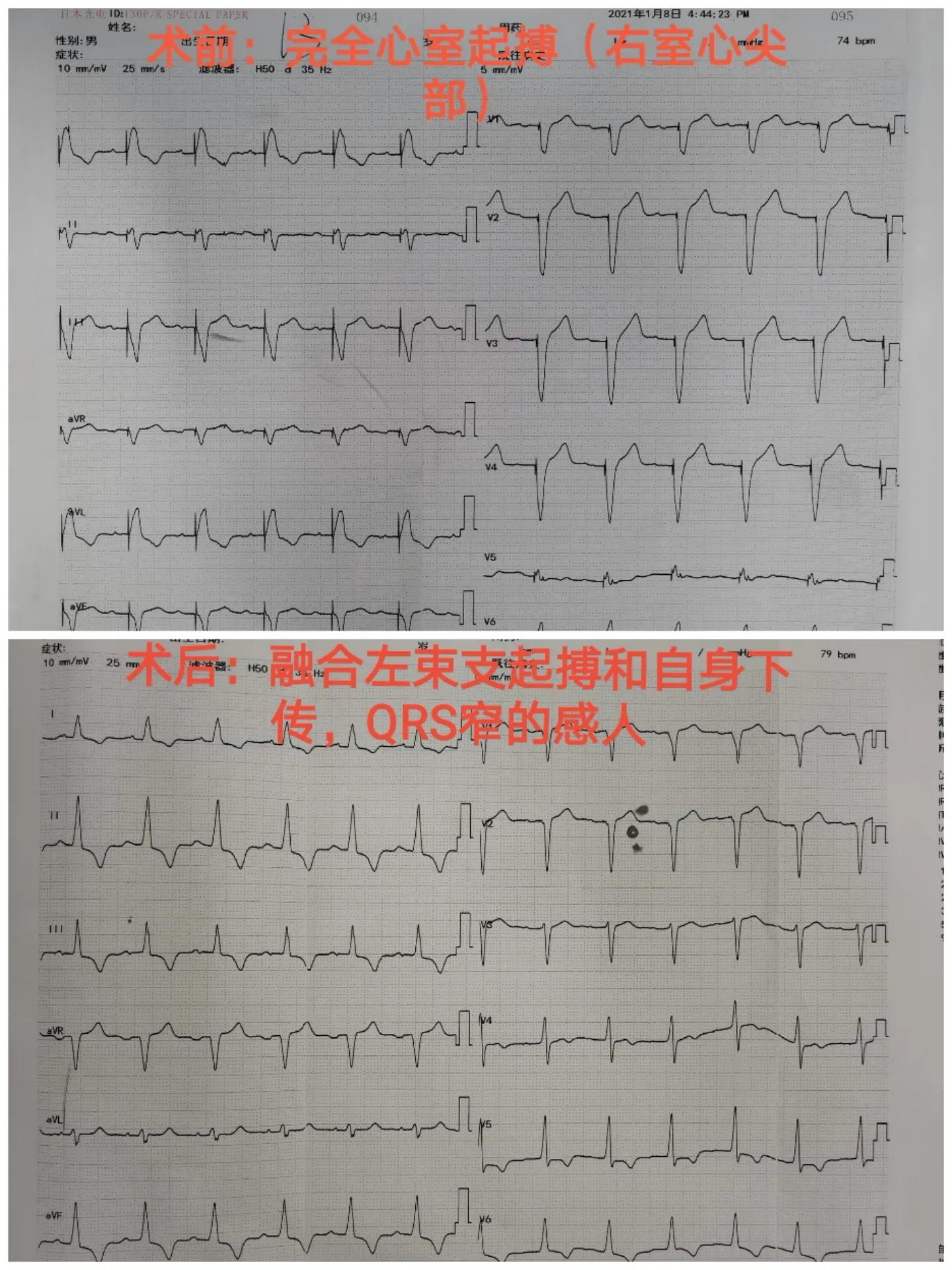 88岁老人心跳过快需要装起搏器吗,老人胸闷气短找中医看可以吗