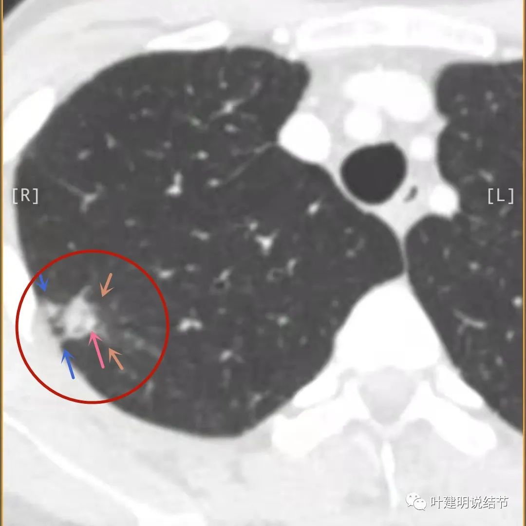 临床诊断孤立性肺结节,空洞型结节一般是什么性质