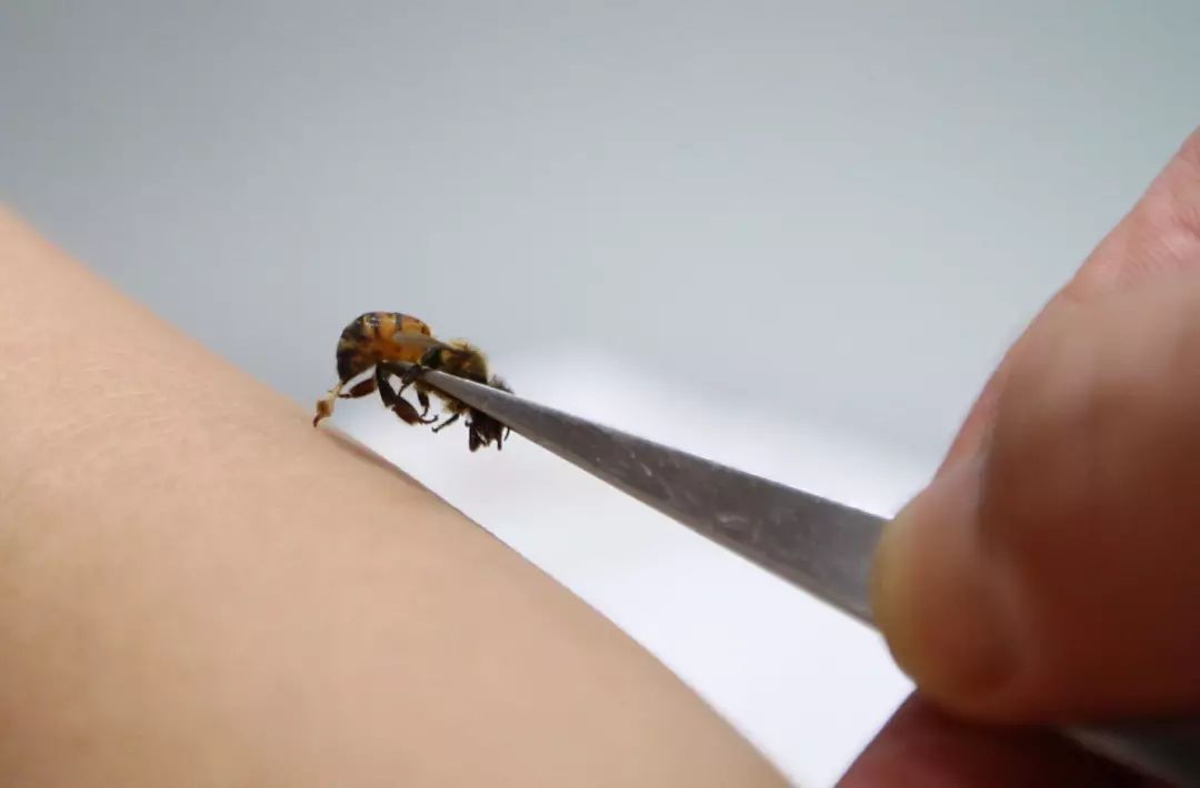 被蜂蜇伤后最简单的处理办法,被蜂蜇了怎么处理更有效