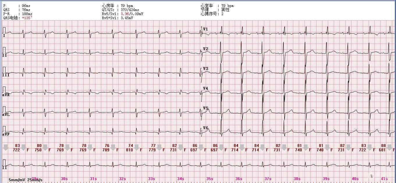 女性心脏供血不足的症状怎么调养,体检结果显示心肌供血不足