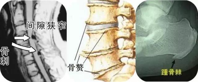 骨刺是什么东西,腿膝盖骨刺怎么治疗好得快