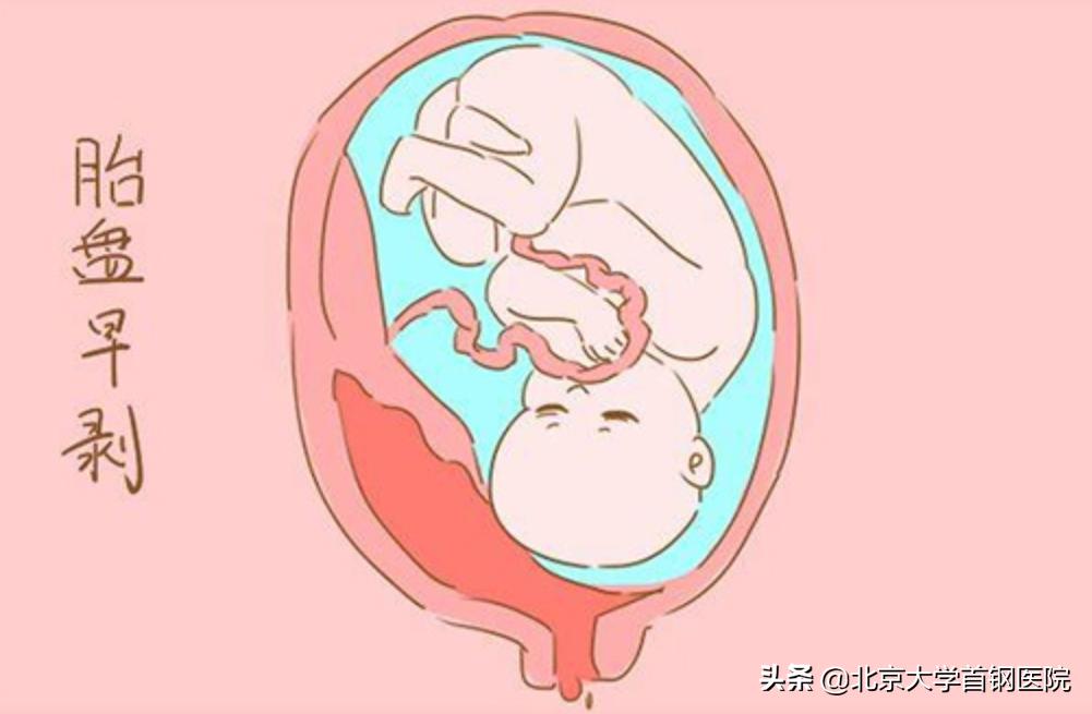 胎盘增厚是nt增厚吗,胎盘突然增厚会导致胎盘早剥吗