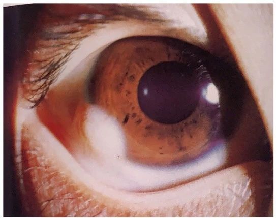 眼睛起了大水泡,我眼睛里面长了一个水泡