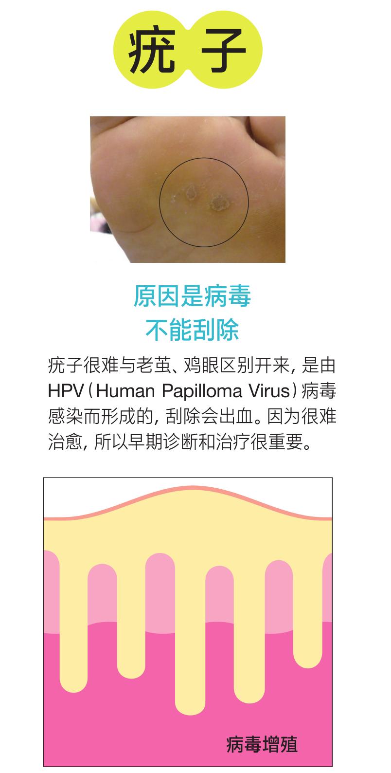 硬邦邦的老茧，会痛的鸡眼，日本皮肤科专家教你矫正足部恶习