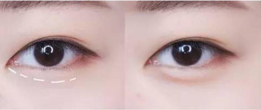 你知道卧蚕和眼袋的区别吗,别把卧蚕当眼袋