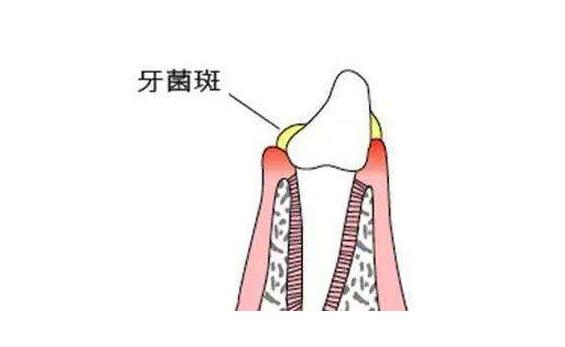吃了维生素c牙龈出血是什么原因,牙龈经常出血与缺少什么有关