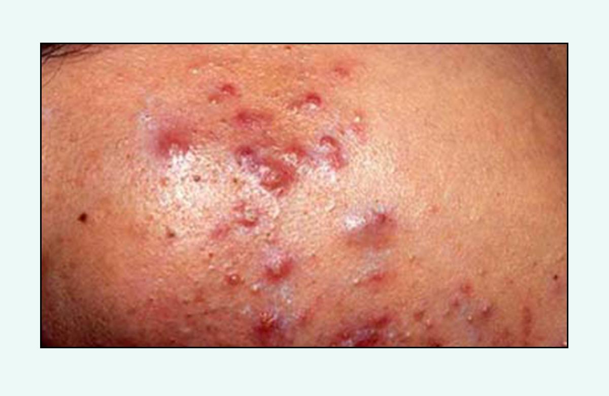 脸上的红疙瘩怎么彻底消除,脸上红疙瘩的种类