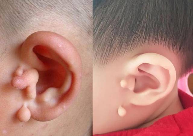 小孩耳朵里内侧有个小洞洞,小孩耳朵前边有个小肉球