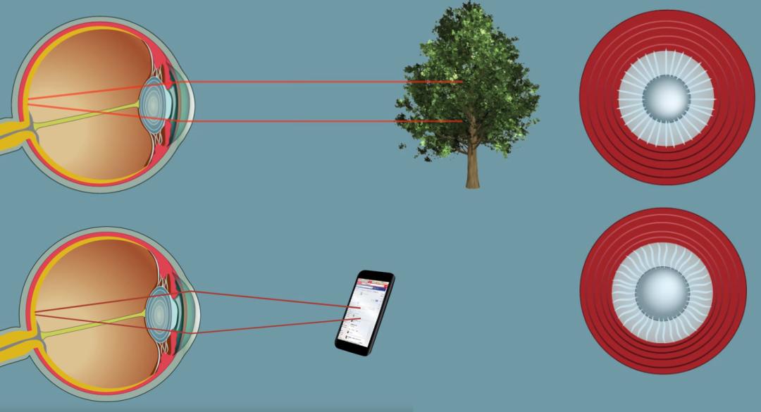 近视不到100度,要戴眼镜吗?达达眼科告诉你