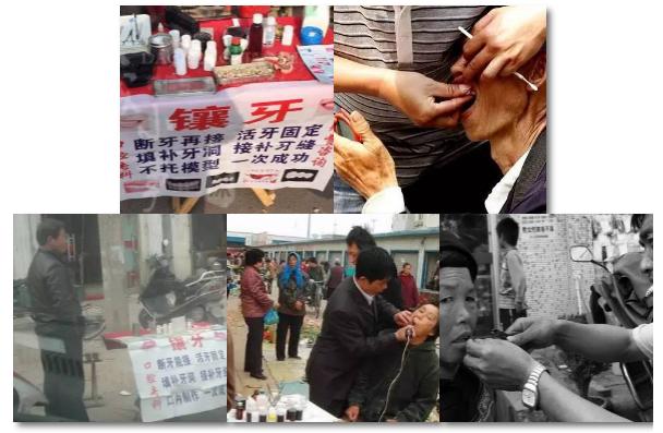 江湖无痛拔牙方法,真正的无痛拔牙