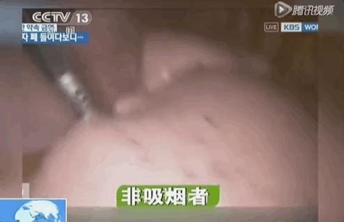 打开死者的肺,才明白有3亿人,在悄悄花钱买死