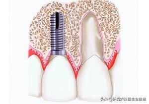 牙医解说蛀牙的危害,医师谈种植牙的手术与维护