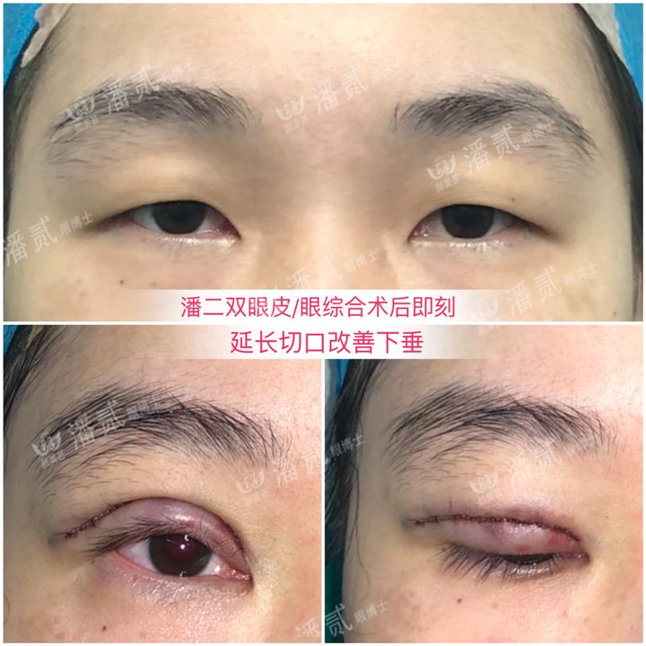 割了开扇双眼皮眼尾上扬太宽,眼尾上扬的眼睛适合什么双眼皮