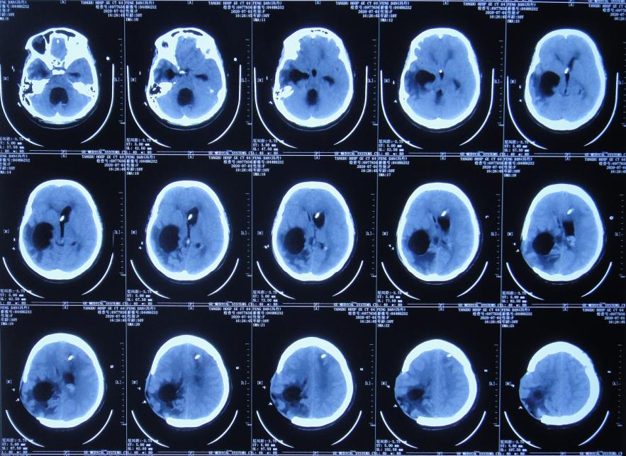 脑室有粘连脑积水有什么办法,脑动脉畸形手术后出现急性脑积水