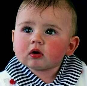 冬天宝宝脸红红是冻疮,冬季注意宝宝冻疮的预防