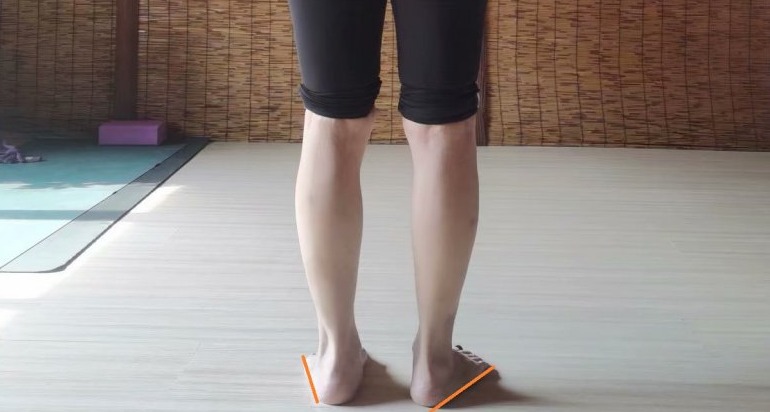 小腿外翻膝超伸如何改善,单侧膝超伸导致腿短一点