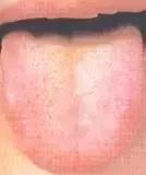 老中医舌苔从厚变薄了,任博士老中医讲舌苔