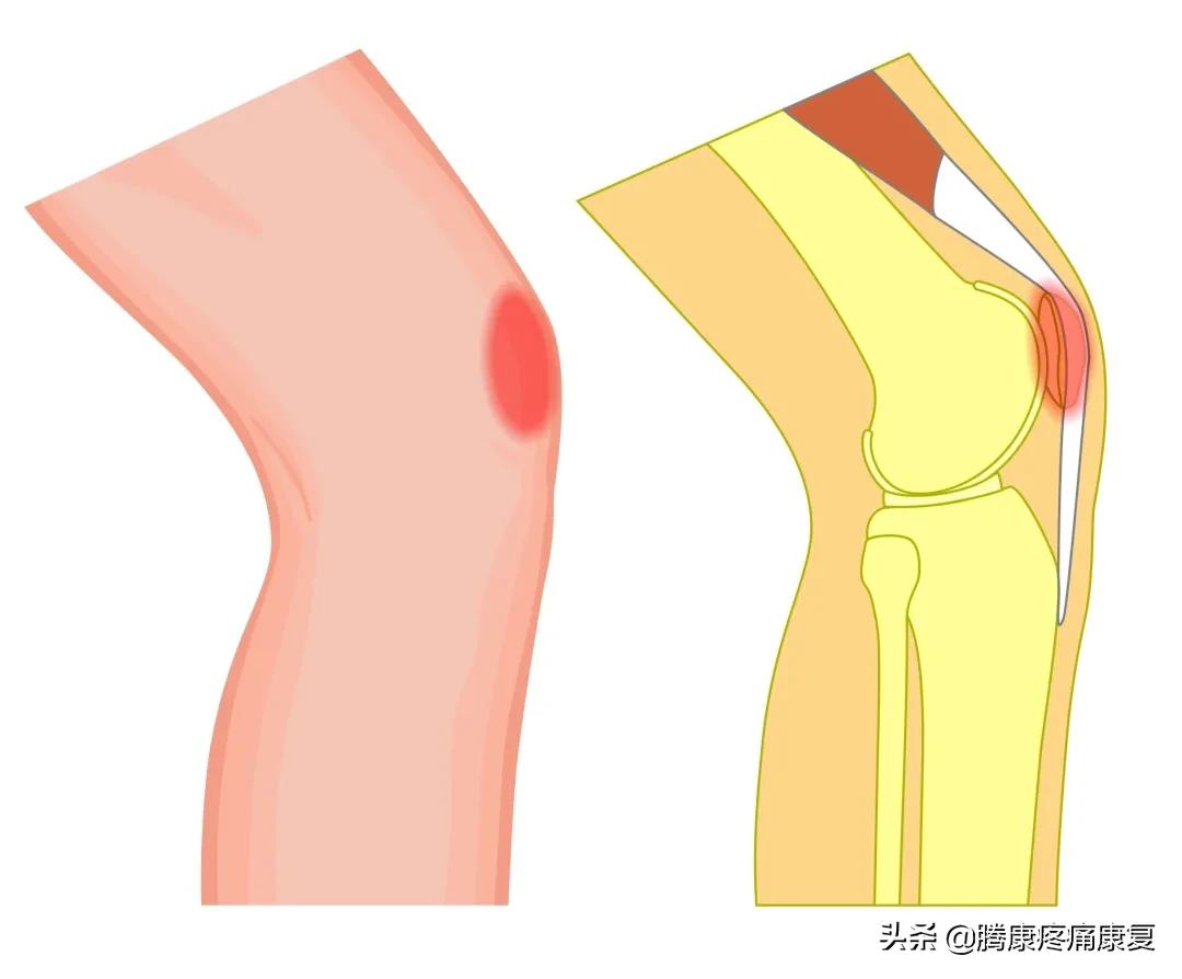 髌股关节疼痛综合症怎么恢复,髌腱疼痛怎么康复