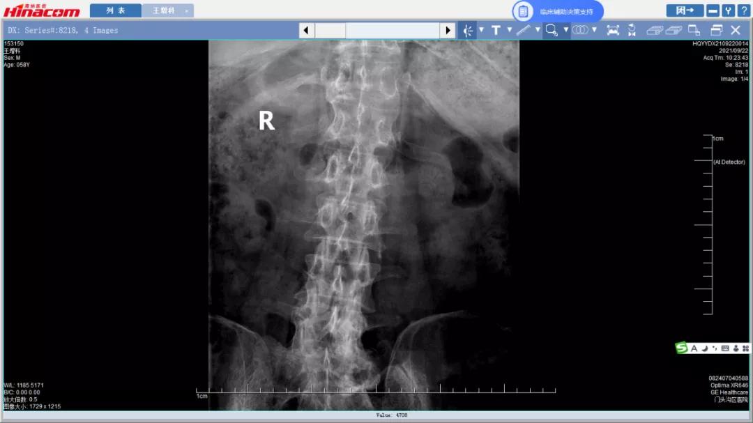 再也不用歪着身子走路了—区医院脊柱中心（骨二科）成功实施腰椎间盘摘除、椎间植骨融合钉棒内固定术