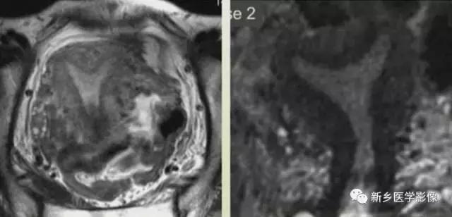 常见的几种子宫畸形诊断标准,先天性子宫畸形是什么原因造成的