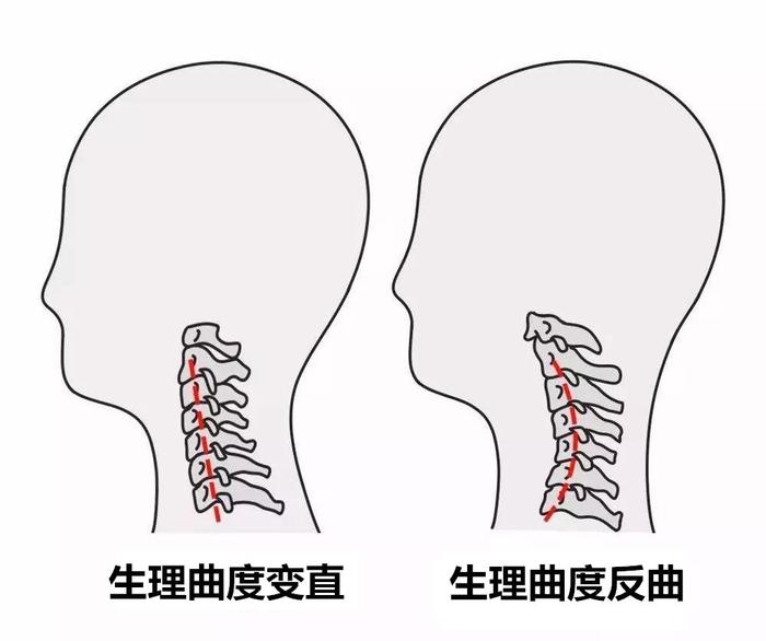 颈椎生理曲度消失,颈椎生理曲度消失怎么办