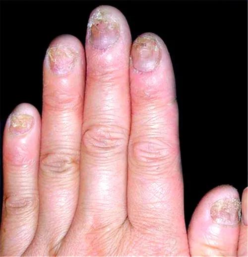 为啥得灰指甲,为什么患上灰指甲