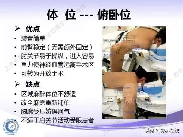 肘关节镜手术后引流,肘关节镜微创手术