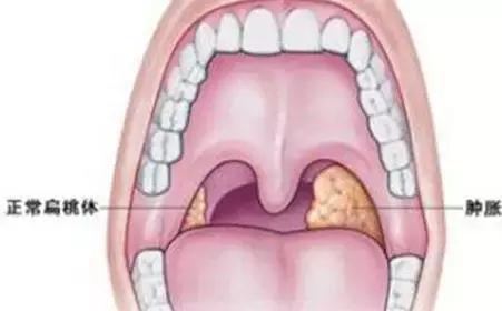 扁桃体总发炎该不该切掉,扁桃体手术要切掉什么结构