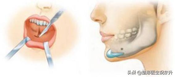 下巴假体好还是注射玻尿酸好,下巴是假体好还是玻尿酸好