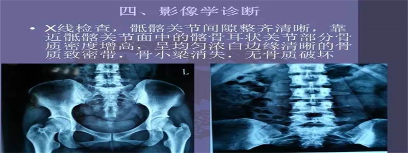 骶骨向后突正骨手法,骶髂骨倾斜正骨手法视频