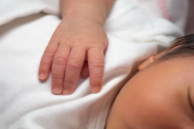 新生儿脱皮很严重是什么原因,新生儿有点脱皮什么原因